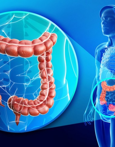 Bowel cancer - causes