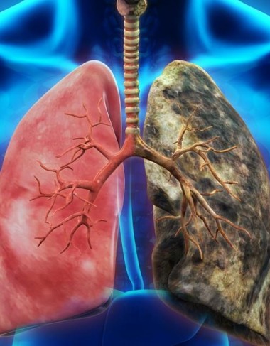 What is lung cancer - Symptoms of lung cancer